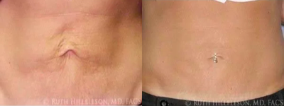 45-54 year old woman with Crepey  abdominal skin treated with Two Thermages spaced 6 Months apart - Patient treated with Two Abdominal Thermages spaced 6 months apart.
