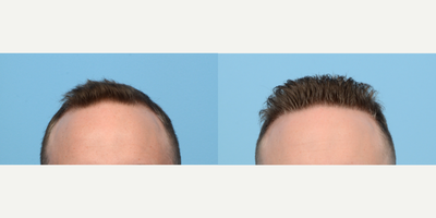 35-44 year old man treated with FUE Hair Transplant, Hair Transplant, Hair Loss Treatment, PRP for Hair Loss, NeoGraft - Looking to strengthen his hairline and combat thinning at the top of his scalp, this 35-year-old patient opted for an FUE Hair Transplant  Dr. Wise transplanted 3,035 grafts in zones 1 and 4. One year post-op, he's loving his renewed, rejuvenated appearance.