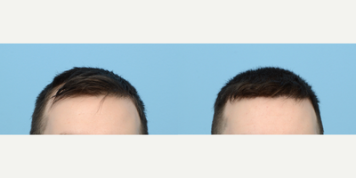 25-34 year old man treated with FUE Hair Transplant, Hair Transplant, Hair Loss Treatment, PRP for Hair Loss, NeoGraft - This 29-year-old patient was experiencing hair loss progressively over the last few years and wanted to regrow and fortify his existing hair. Dr. Wise performed an FUE hair transplant with 2,250 grafts and one treatment of PRP therapy. One year post-op the patient's thrilled with his results!