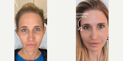 Woman treated with PlasmaPen - Woman treated with PlasmaPen