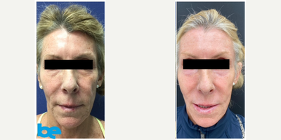 55-64 year old woman treated with MiXto Laser - 55-64 year old woman treated with MiXto Laser