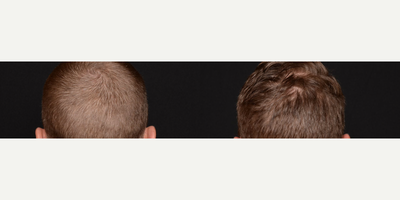 Woman treated with NeoGraft, Hair Transplant - Dont let hair loss get you down!Here at Beyond Beautiful, we offer the NeoGraft Hair Transplantation System to men and women who suffer from male/female pattern baldness or thinning hair. We believe that hair restoration doesnt just give back the hair that was lost, it can also help to reestablish ones self-confidence to help you not only look better but FEEL better!