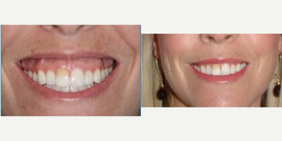 35-44 year old woman treated with Lip Lowering - This patient's gummy smile was treated with upper lip lowering so the upper lip appears to be more full.