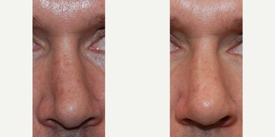 35-44 year old man treated with Nonsurgical Nose Job, Silikon 1000 - This is an excellent example of the precision, permanence, and safety of non-surgical nose job treatments with microdroplet Silikon-1000. Our patient had previously undergone rhinoplasty surgery elsewhere, and he was primarily concerned with nasal asymmetry caused by an exaggerated indentation along his right supra-alar crease. The after photo shows a permanent result following two treatments with microdroplet Silikon-1000. You can see a more natural, less operated nasal appearance, and our patient was grateful to have a permanent alternative to revision rhinoplasty surgery, which carries many more risks, uncertainties, and expenses. Microdroplet Silikon-1000 injections have a proven track record of safety when used for non-surgical revision rhinoplasty procedures for over 60 years.