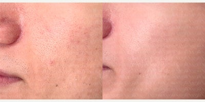 25-34 year old man treated with PRP Injections, Micro Botox - This patient was concerned with visible pores and uneven texture around the cheeks and nose. We performed a customized treatment combining PRP (Platelet-Rich Plasma) to stimulate collagen regeneration and Micro Botox to refine pore appearance and balance sebum production.Photos taken before and 4 weeks after the treatment.Notice the smoother skin texture and refined pore appearance, especially in the mid-cheek area. Results will continue to improve over time with proper skin care and follow-up treatments.