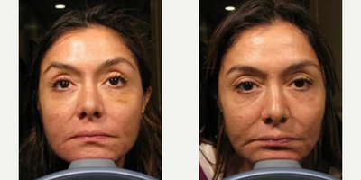 Woman treated with Infini RF - Woman treated with Infini RF