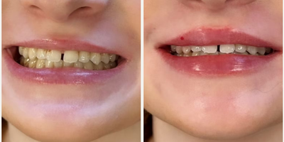 Woman treated with Lip Fillers - Woman treated with Lip Fillers