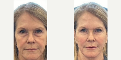 Woman treated with Lip Fillers - Woman treated with Lip Fillers