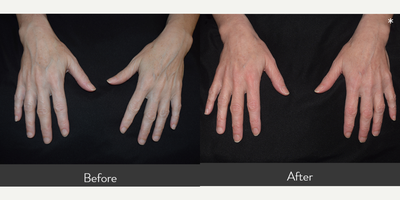 45-54 year old woman treated with Aquagold and DermaPen with PRP - Our 52 yr. old pt. wanted to focus on thickening her skin without the use of fillers or lasers. She had 4 treatments using Aquagold with PRP to her hands and 3 treatments using a combination of Aquagold and DermaPen with PRP to her abdomen. Treatments were done 4-6 weeks apart. Her veins are no longer available, her abdomen is noticeably tighter, and belly button is higher. *Great option for someone with very thin skin who is hesitant about the use of fillers. Through the use of ultrasound technology and taking dermal measurements each visit, we have data proving that her overall skin thickness increased after each session