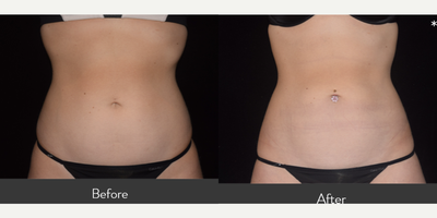 25-34 year old woman treated with CoolSculpting Elite - Our 27 year old patient previously had 1 CoolSculpting session to her anterior waist. She was happy with her result so she desired to treat her abdomen and waist to have an overall improvement. She is seen before and 8 weeks after 1 CoolSculpting Elite session to her lower abdomen, upper abdomen, high upper abdomen, anterior waist and posterior waist