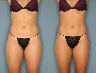 Velashape - Photos provided courtesy of Syneron, Ruthie Amir, MD