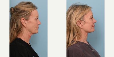 55-64 year old woman treated with Deep Plane Facelift, Neck Lift, Brow Lift, Eyelid Surgery, Facial Fat Transfer, CO2 Laser - Our patient came to us seeking a natural, refreshed lookhoping to restore youthful contours to her cheeks and eliminate excess skin. The results of her transformation are truly remarkable. Her jawline is now beautifully defined, volume has been restored to her face, and her skin appears firmer and naturally rejuvenated. To achieve this outcome, Dr. Balikian performed a comprehensive facial rejuvenation procedure, which included a preservation deep plane facelift, deep vertical neck lift with submandibular gland reduction, temporal brow lift, bilateral upper blepharoplasty, full face fat transfer, and full face CO2 laser. Each component of this tailored approach worked in harmony to produce balanced, natural-looking results that reflect Dr. Balikians artistry and expertise.