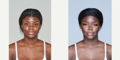 25-34 year old woman treated with Cheekbone Reduction - Rhinoplasty, Facial contour - cheekbone reduction, jaw angle reduction, genioplasty, facial liposuction