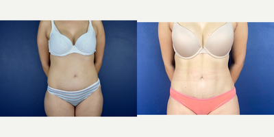 35-44 year old man treated with Liposuction, Power-Assisted Liposuction (PAL), Vaser Liposuction - Female patient with previous tummy tuck ask to improve her abdominal shape and definition,  She had a High definition lipo with Microair and ultrasound.