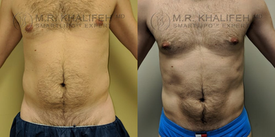 25-34 year old man treated with Liposculpture - This is a thin man who had stubborn fat in abdomen and lower back flanks, treated with awake Liposuction