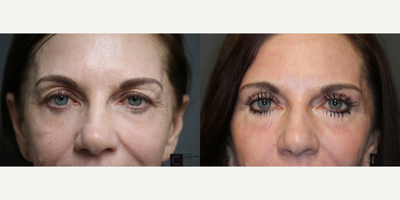 Silhouette Soft - Laser treatment with a lift.