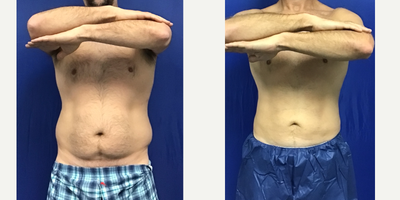 45 year old man treated with Tickle Lipo & Renuvion Skin Tightening - 45 year old male patient before and after having 2750ml of fat removed from his upper/lower abdomen and flanks via Tickle Lipo, followed up with some Renuvion Skin Tightening. 3 months post-op.