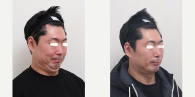 35-44 year old man treated with AccuLift, Liposuction, Laser Liposuction - 39 Years old male patient Chief Complain: Bulky cheeks, overal puffiness and the lack of masculine contours, looking gloomy and more older then his real age. Puffy, tired undereye areaTreatment Plan: undereye fat reposition, face liposuction (double chin, cheek bone, cheeks, near mouth)Outcome: pure fat liposuctioned : double chin (-30cc), middle face line (- 50cc) fresher and more youthful face shape, reduce exessive fat, more refined appearance and masculine shaped jaw line.