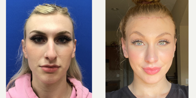 Patient treated with MTF Facial Feminization Surgery - 18 to 24 year-old female patient is 3 months post-op from Facial Feminization surgery. Her procedures included: Forehead Lift, Hairline Lowering, Orbital Bony Contouring; Septorhinoplasty (Closed) with Cartilage Grafts, Radix Graft and Weirs; Cheek Implants (Small); Chin Reduction and Contour; Subnasal Lip Lift with Fat Augmentation to Lips; Thyroid Cartilage Shave and 300 Micrografts to Recessions.