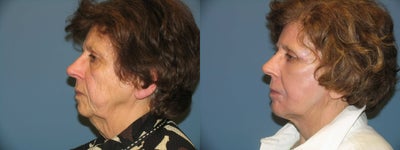 Quicklift w/neck liposuction - 
	Patient had Quicklift with neck lipo, naturalfill, laser resurfacing, brow lift, upper and lower eyelids and chin implants.
