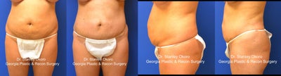 Mini Tummy Tuck - 
	Satisfied Patient requested removal of abdominal excess fat and lower abdominal excess skin. Mini Tummy Tuck (Mini-Abdominoplasty) &amp; state-of-the art Five (5) step body sculpting process including micro cannula laser liposuction (SmartLipo) was performed. Procedure performed in the office procedure room using oral sedation without general anesthesia. IV sedation &amp; General anesthesia is available on request.
