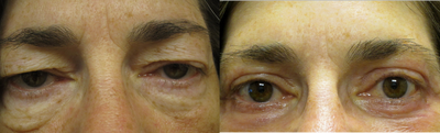 55 year old woman treated for droopy eyelid and eyelid bags - 
	55 year old woman treated for droopy eyelid and eyelid bags
