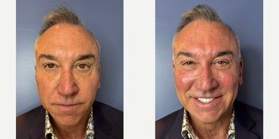 55-64 year old man treated with Cheek Fillers, Dermal Fillers, Juvederm, Voluma - Patient received 1cc of Juvederm Voluma to each cheek.