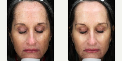 55-64 year old woman treated with BroadBand Light (BBL) - Patient received one BBL treatment to treat brown spots.