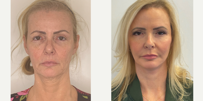 55-64 year old woman treated with Facelift, Neck Lift, Facial Fat Transfer, Chemical Peel, Eyelid Surgery - 57 year old patient 2 months after a Facelift, Neck lift, Upper Blepaharoplasty, facial fat transfer and a TCA chemical peel.