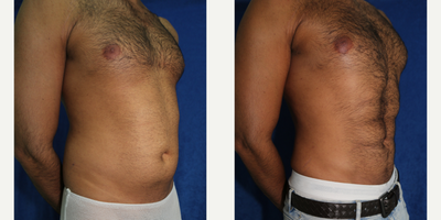 25-34 year old man treated with Abdominal Etching - This patient in his early 30s had poor abdominal definition despite his constant working out. He underwent VASER Hi-Def Abdominal liposuction to remove fat from the rectus abdominis musculature. This leads to a more visible rectus abdominis musculature (or six-pack abs).