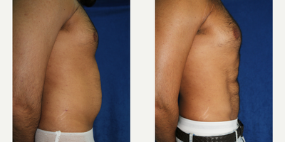 25-34 year old man treated with Abdominal Etching - This patient in his early 30s had poor abdominal definition despite his constant working out. He underwent VASER Hi-Def Abdominal liposuction to remove fat from the rectus abdominis musculature. This leads to a more visible rectus abdominis musculature (or six-pack abs).