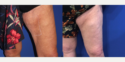 55-64 year old woman treated with Ultherapy - My 68 year old patient wanted a non invasive skin tightening procedure to tone and tighten inner arms and thighs. Here she is 8 months post treatment after 1 session.