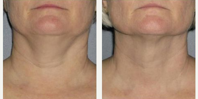 Woman treated with Ultherapy - Woman treated with Ultherapy