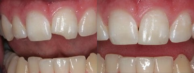 18-29 year old woman treated with Dental Bonding - 18-29 year old woman treated with Dental Bonding