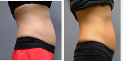 35 year old woman treated with UltraShape Power - 35yr old female 3 sessions of UltraShape Power and VelaShape III. Photos are from 2 weeks after final session. Sessions were 2 weeks apart.