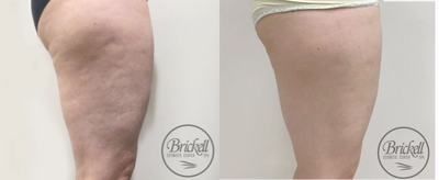 35-44 year old woman treated with Velashape - Final results after 7 treatments