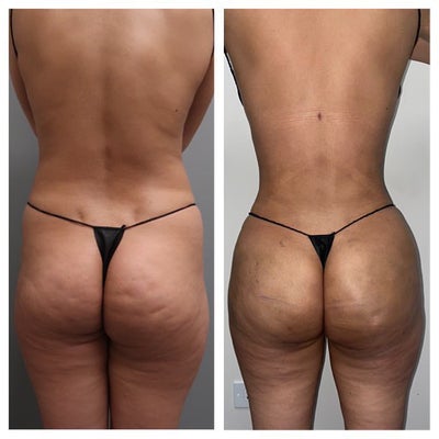 How to Achieve the Appearance of a Butt-Lift without Surgery - Hourglass  Angel