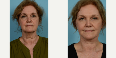 Woman treated with Lower Facelift - Woman treated with Lower Facelift