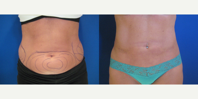Laser Liposuction - Abdomen - Abdomen