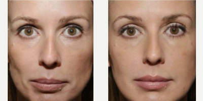 35-44 year old woman treated with Sculptra Aesthetic - 35-44 year old woman treated with Sculptra Aesthetic to help fill hollow areas in the face.