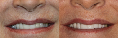 45-54 year old woman treated with Dental Crown - Crowns done to remake smile