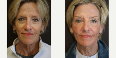 Mini Vidalift, Enigmalift Surgery and Laser Resurfacing - Mini Vidalift with Enigmalift scarless lower eye bag removal and photodynamic laser resurfacing.