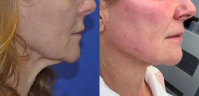 45-54 year old woman treated with Liquid Facelift - y lift done with juvederm voluma and juvederm ultra plus xc