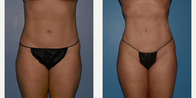 35-44 year old woman treated with Rib Removal - Rib removal