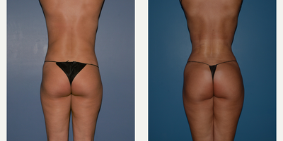 35-44 year old woman treated with Rib Removal - Rib removal
