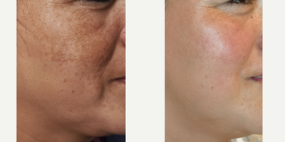 45-54 year old woman treated with Cosmelan - Melasma can be an extremely difficult condition to manage and to live with.  Dark patches like these can cause social anxiety and embarrassment because the condition is not well understood by most.  Consistent use of a high strength, gel based hydroquinone formulation gets and keeps Melasma under control for our patients.