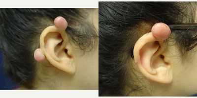 17 or under year old woman treated with Cyst Removal, Mole Removal - 16 year old female before and 2 months after removal of right ear cyst/birthmark. She has had this lesion since birth. She started using Dr. Sperons Natural Skin Care Scar Support Treatment 2 weeks after her surgery twice a day. The dog ear superiorly will flatten with massage and a bit more time. She's very happy with the minimal scarring and is scheduled to have removal of the other one soon.