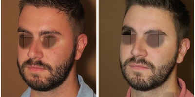 Man treated with Buccal Fat Removal - Man treated with Buccal Fat Removal