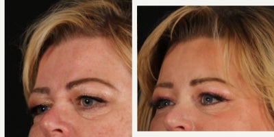 55-64 year old woman treated with Eyelid Surgery, Brow Lift - 3 months out from brow lift and upper blepharoplasty for our beautiful patient with a history of bell's palsy. Thank you to her for allowing us to share!