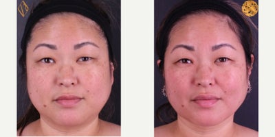 35-44 year old woman treated with FaceTite - FaceTite with facial and submental liposuction performed in conjunction with buccal fat reduction to achieve a slimmer facial contour in a woman in her early 40s. Results shown 1 month post-procedure.